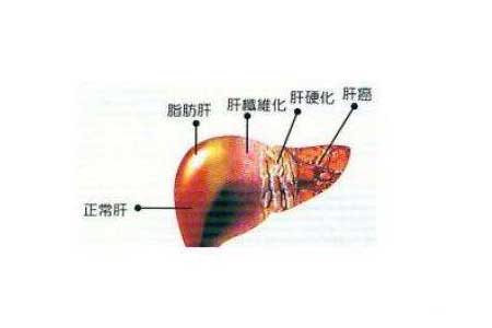 脂肪肝变化过程