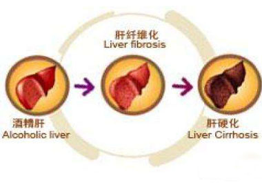 从酒精肝到肝癌只需这几步 它是抗癌之王不妨试一试