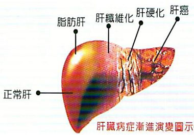 脂肪肝演变过程