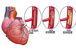 为什么冠心病在冬季高发?预防冠心病的方法补硒