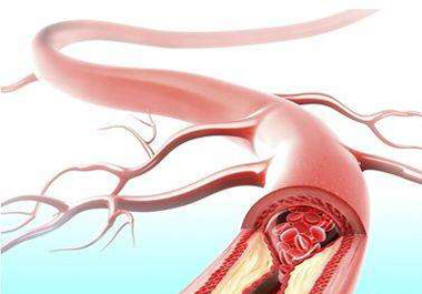 预防动脉粥硬化需补硒