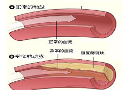 有了动脉粥样硬化怎么办