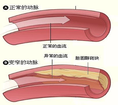 动脉粥样硬化补硒