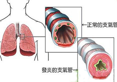 支气管炎补硒改善肺部功能