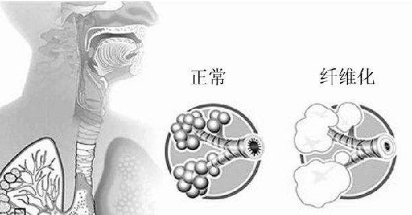 肺纤维化对比图