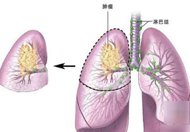 得了肺癌之后 补硒有没有用