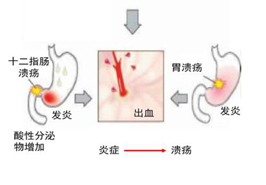 补硒预防胃炎的发生