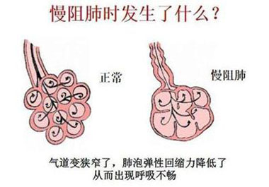 慢性阻塞性肺疾病的症状及预防缓解措施有哪些