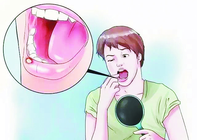 口腔溃疡不是只需要补充维生素C，它们也是必不可少