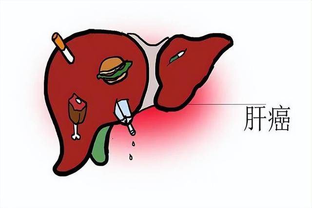 你知道吗 肝癌都是拖出来的